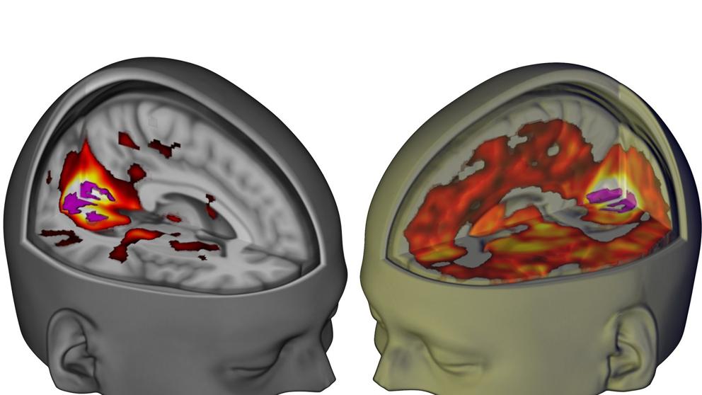 cerebro-LSD