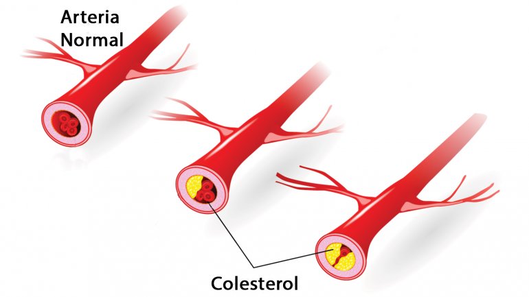 anticolesterol